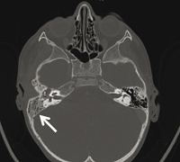 Acute mastoiditis, a severe complication of acute otitis media in children – prevalence, diagnosis and treatment