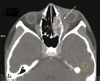 Orbital complications of acute rhinosinusitis in children: a retrospective review of 33 patients