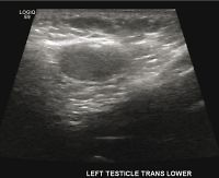 A practical guide to cryptorchidism for the primary care physician