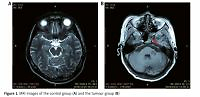 The role and significance of magnetic resonance imaging
and miRNA-125b expression level in diagnosis of head
and neck squamous cell carcinoma