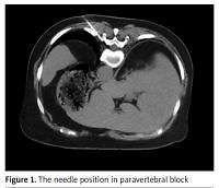 The effectiveness of repetitive paravertebral block with
ropivacaine and dexmedetomidine for the prevention
of postherpetic neuralgia in patients with acute herpes
zoster
