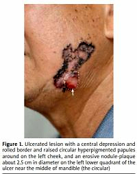 Myoepithelial differentiation subsequent to giant basal
cell carcinoma in the left face