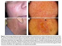 Clinical and histopathological characteristics of primary
and recurrent basal cell carcinoma: a retrospective study
of the patients from a tertiary clinical centre
in the northern Poland