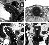 Pictorial essay: Magnetic resonance imaging in cervical cancer interventional radiotherapy (brachytherapy): 
a pictorial essay focused on radiologist management