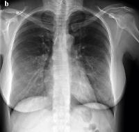 Pulmonary oedema during intravenous tocolysis with fenoterol: a case report