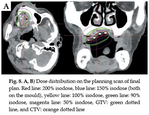 Surface mould brachytherapy in a completely edentulous hard palate carcinoma using an innovative technique: One size does not fit all