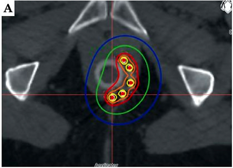 Chemoradiotherapy for anal canal cancers: Does the choice of boost technique matter?