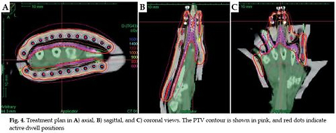 A novel patient-specific solution for Merkel cell carcinoma in high-dose-rate brachytherapy