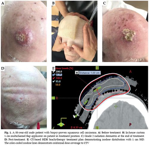 Dosimetric evaluation of superficial radionuclide-based high-dose-rate brachytherapy for deep keratinocyte carcinoma: A case series