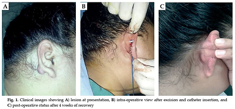 Efficacy of peri-operative high-dose-rate interstitial brachytherapy in keloids: Can we scare the bad scar?
